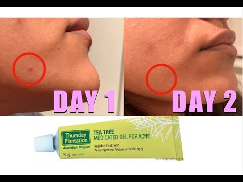 TESTING TEA TREE ACNE GEL: HOW MANY DAYS TO GET RID OF A ZIT