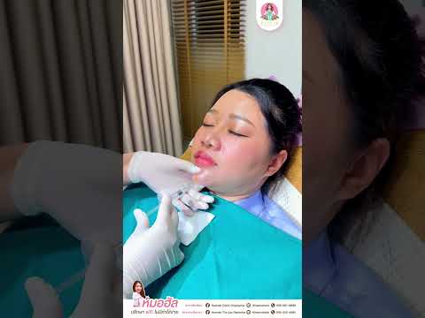 รีวิวหัตถการโปรแกรมฟิลเลอร์คาง