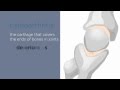 Arthritis