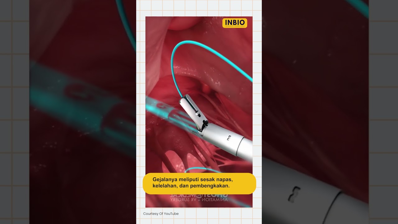 Heart valve surgery process