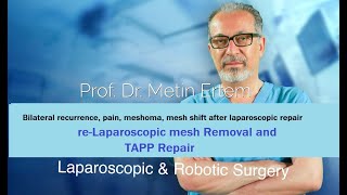 Miniaturka - Laparoscopic recurrent hernia . re-Laparoscopic TAPP Repair. Metin Ertem MD.FACS