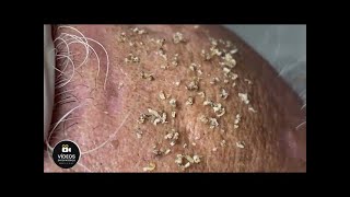 Removendo cravos e espinhas do rosto - Tratamento para pele - Vídeo Satisfatório 😱