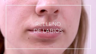 Relleno de labios con Ácido Hialurónico