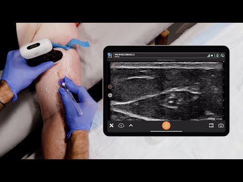 Peripheral IV Cannulation