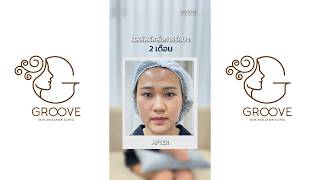 สิวจากเมคอัพ หน้าใส