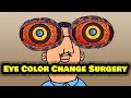 Eye Color Change Surgery