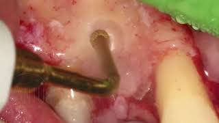 Dental Cyst Removal by using PiezoSurgery