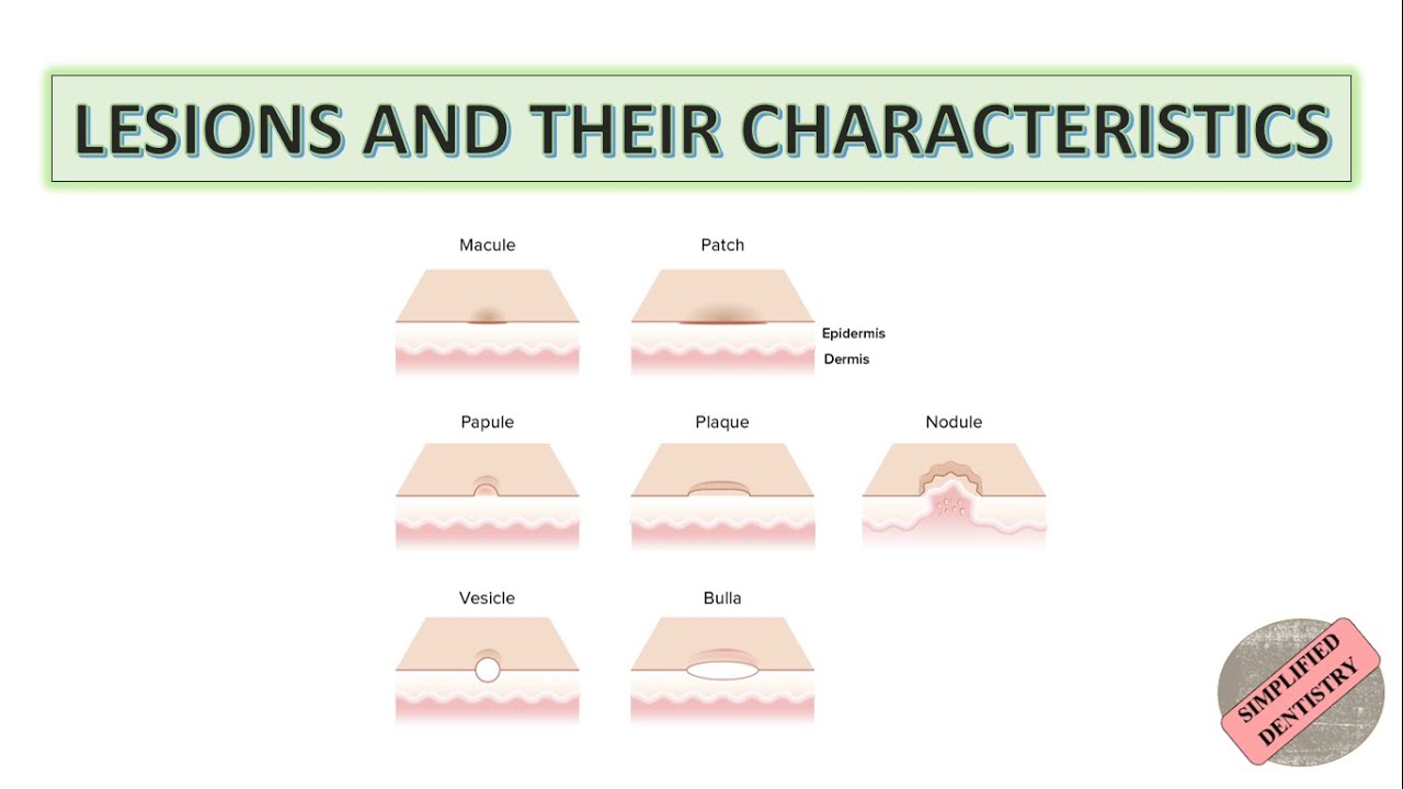 Lesions and their characteristics