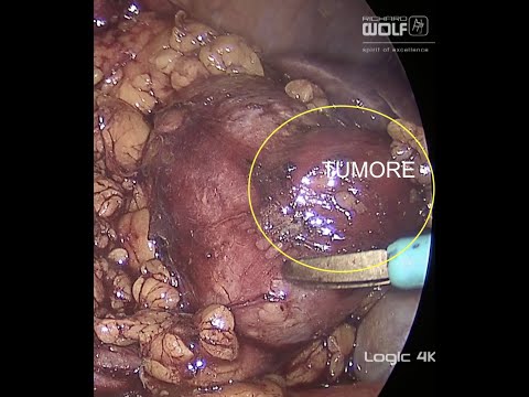LAPAROSCOPIC PARTIAL NEPHRECTOMY TRANSPERITONEAL APPROACH