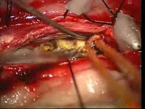 Removal Of A Large Neurofibroma Of The Intradural Thoracic Region