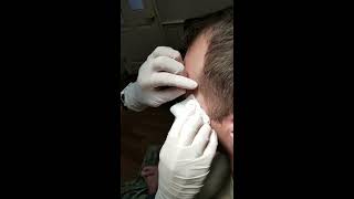 Draining an Inflamed Cyst on Face