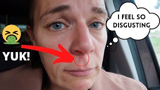 I FEEL DISGUSTING (impetigo???) | BRITISH FAMILY LIFE IN SPAIN // staph infection? Strep infection?