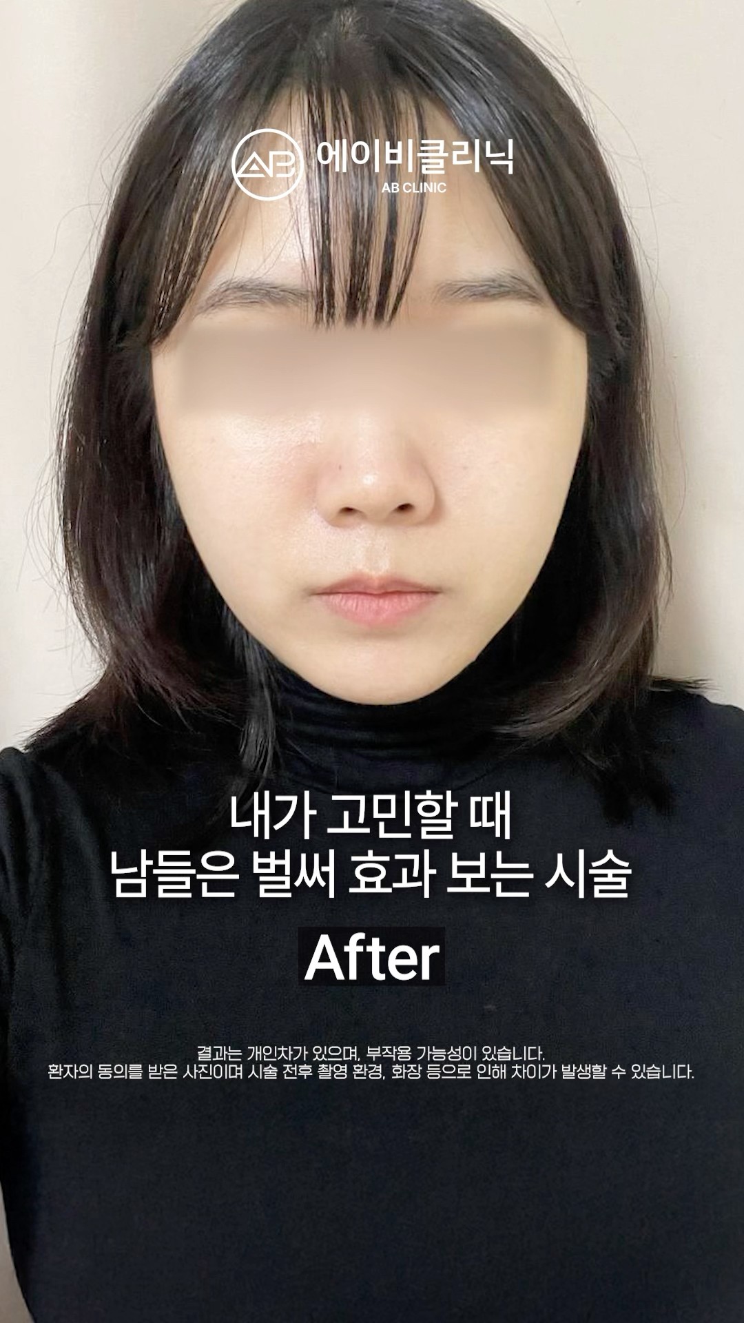 고민할 시간도 아까운 울쎄라 전후💘