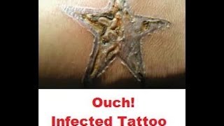 preview picture of video 'Tattoo Doctor Tattoo Infection Remedy | Tattoo Infection Treatment'