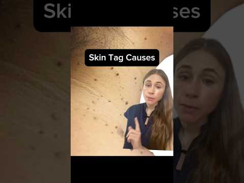 The Real Reason You're Getting More Skin Tags