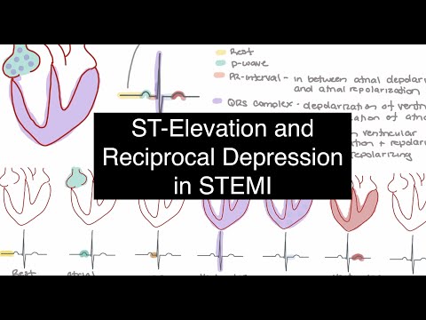 ST Elevation and Reciprocal Depression in STEMI