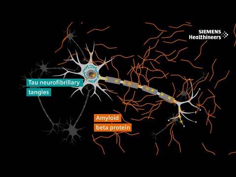 Alzheimer’s disease diagnosis explained | The role of PET and MRI