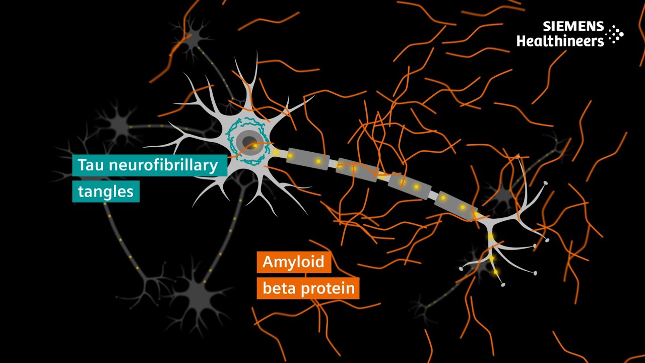 Alzheimer’s disease diagnosis explained | The role of PET and MRI