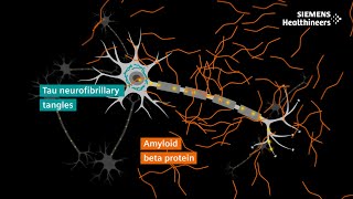 Alzheimer’s disease diagnosis explained | The role of PET and MRI