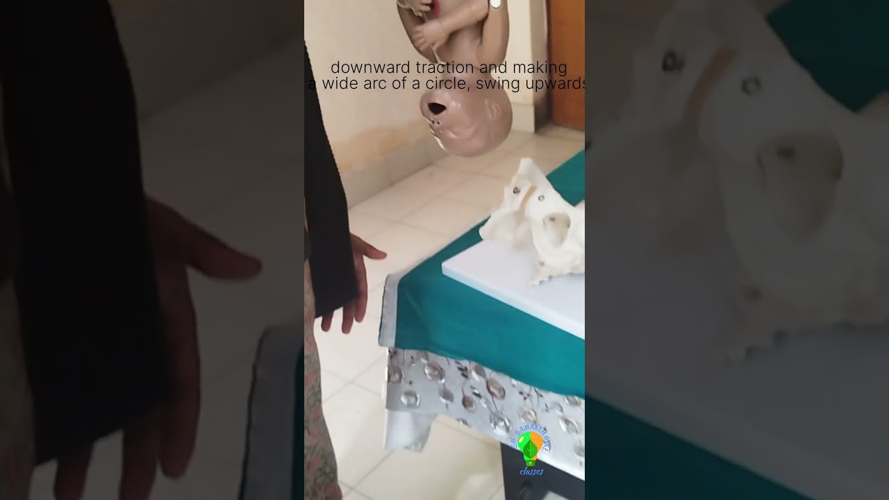 Burns marshall method of assisted breech delievery@Profdrshikhapandey #obstetrician