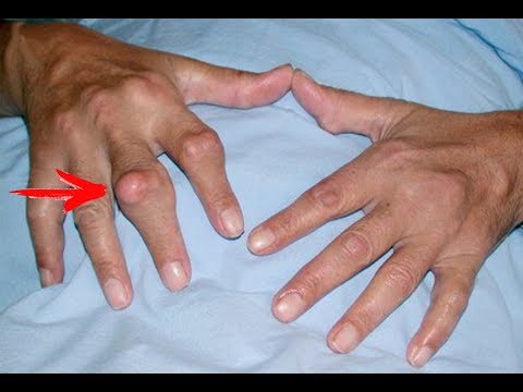 Physiotherapie nach der Entfernung des Meniskus des Kniegelenks Entzündete Gelenke der Hände und Füße