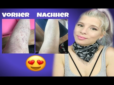 Die Schuppenflechte die Symptome und die Folgen Ob das Eis bei der Schuppenflechte möglich ist