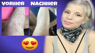 NEURODERMITIS | Meine aktuelle HAUTPFLEGE | UPDATE