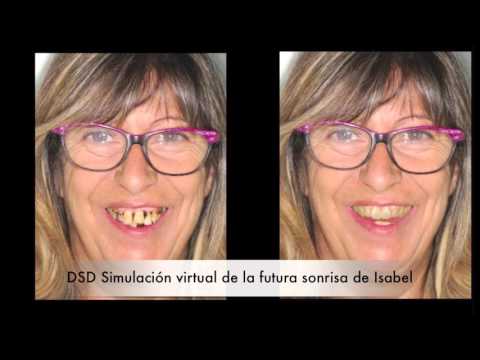 Implantes de carga inmediata.