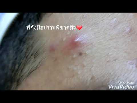 กระดูกสันหลังและความแข็งแรงในผู้ชาย คู่มือรอกโซ่พรู HS-C 101 131 ความคิดเห็น