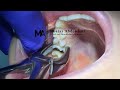 Extraction Of Upper First Molar Using Forceps