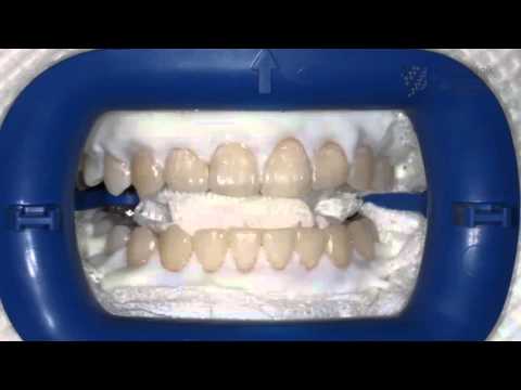 Endlich weiße Zähne: Wie funktioniert Bleaching beim Zahnarzt?