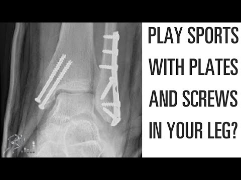 Can I play sports with a plate and screws in my leg?