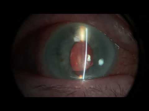 Examination of a corneal ulcer (plus more!)