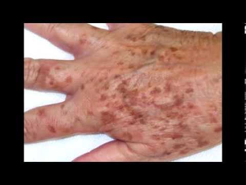 Remedios caseros para las manchas en las manos