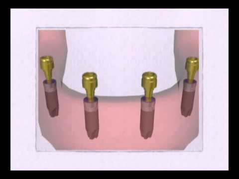 Praxis Dr. Erhard - Stift Protese