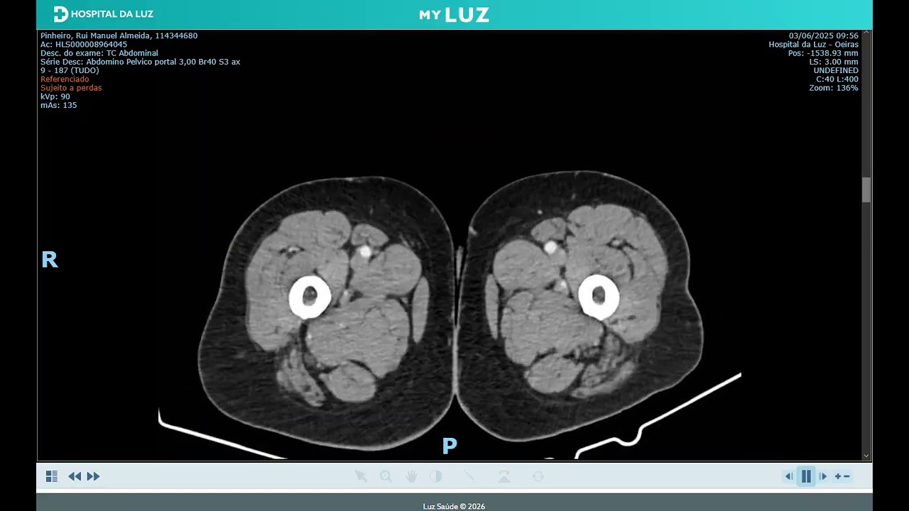 CT with IV Contrast Thumbnail