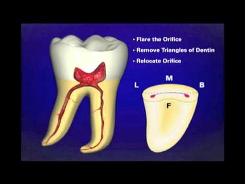 Dr. Ruddle on Access Preparation | Dentsply Sirona