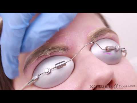 download lagu mp3 mp4 Picosure Laser Eyebrow Tattoo Removal, download lagu Picosure Laser Eyebrow Tattoo Removal gratis, unduh video klip Picosure Laser Eyebrow Tattoo Removal