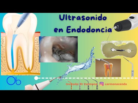 Ultrasonido en Endodoncia