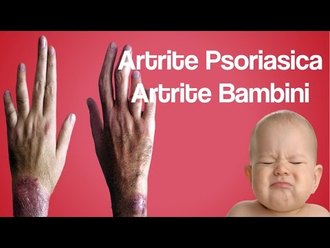 Displasia, la sindrome di ipermobilità articolare Esercizio dopo lestensione del ginocchio