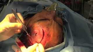 preview picture of video 'EXCISION OF LARGE SQUAMOUS CELL CARCINOMA - DR. TANVEER JANJUA'