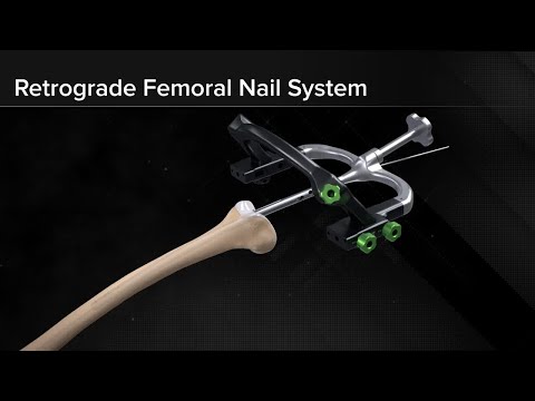 Tibial Nailing - Suprapatellar Technique