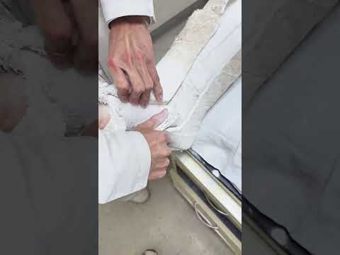 Safely Removing a Cast: Essential Ankle Fracture Recovery!