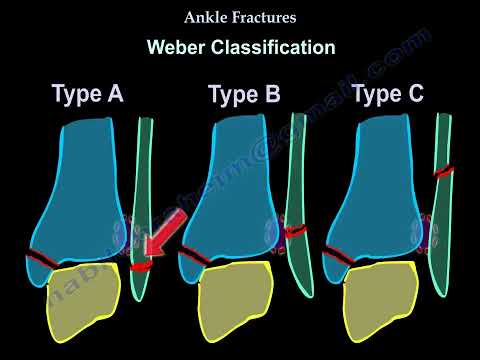 Ankle Fractures  types symptoms and treatment
