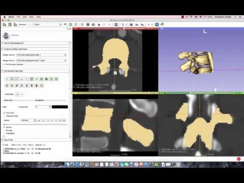 3D Slicer Tutorial: How to Segment a Lumbar Vertebrae