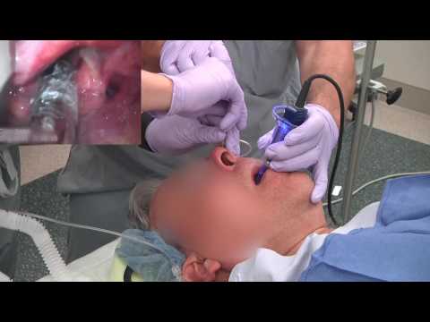 Twisting ETT during nasal intubation from AOD