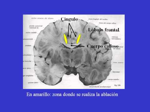 Tratamiento quirúrgico del dolor crónico refractario mediante Cingulotomía Bilateral Estereotáxica