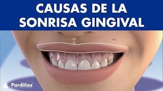 ¿Muestras mucha ENCÍA al SONREÍR? Estas son las causas de la SONRISA GINGIVAL ©