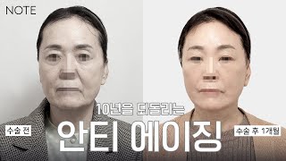 [안면거상 케이스리뷰] 티나지 않게, 과하지 않게 - 그냥 딱 10년전 내 모습으로 l 노트성형외과 l 이보형 원장