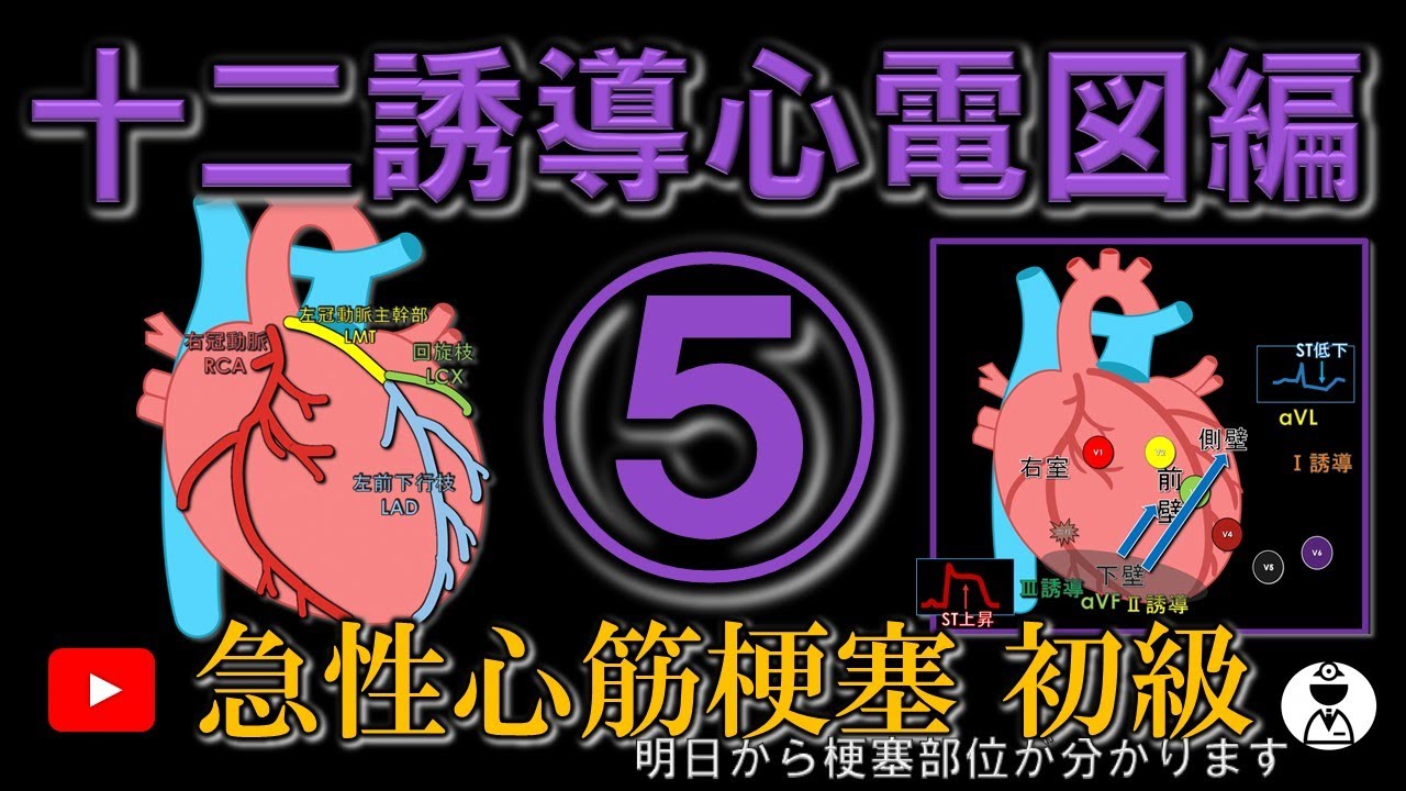 急性心筋梗塞 初級編  (冠動脈と梗塞領域分かります)